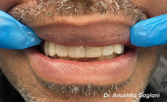 Dental Implants Dentist in Burbank IL