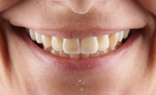 TruBlu Dentistry | CBCT, Sports Mouthguards and Implant Restorations