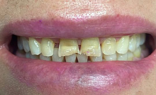 Dental Implants Dentist in Burbank IL