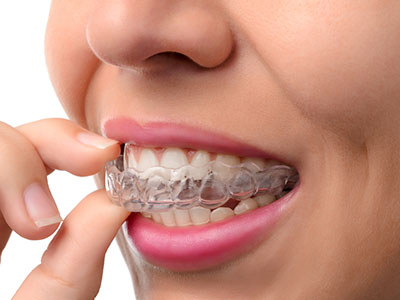 TruBlu Dentistry | E4D, Sports Mouthguards and Implant Restorations