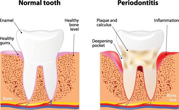 TruBlu Dentistry | Night Guards, Dentures and TMJ Disorders